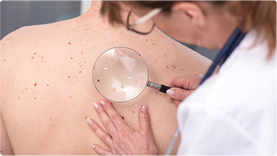 Lietuva vis dar neprieinamas standartinis melanomos gydymas